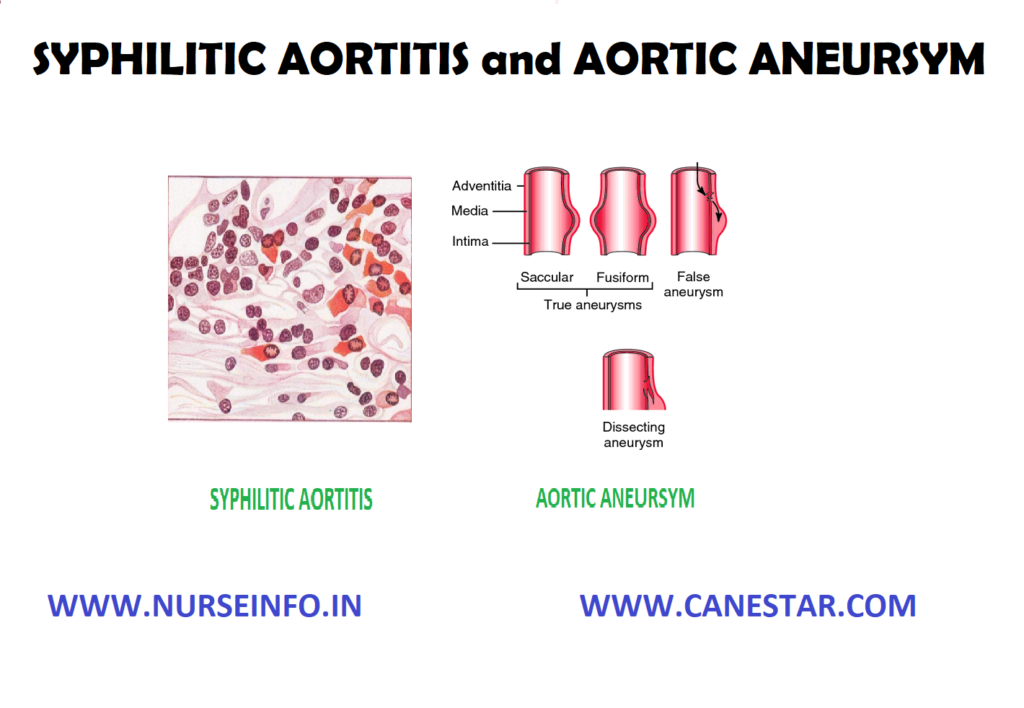 SYPHILITIC AORTITIS and AORTIC ANEURSYM – Causes, Pathophysiology, Clinical Manifestation and Treatment 