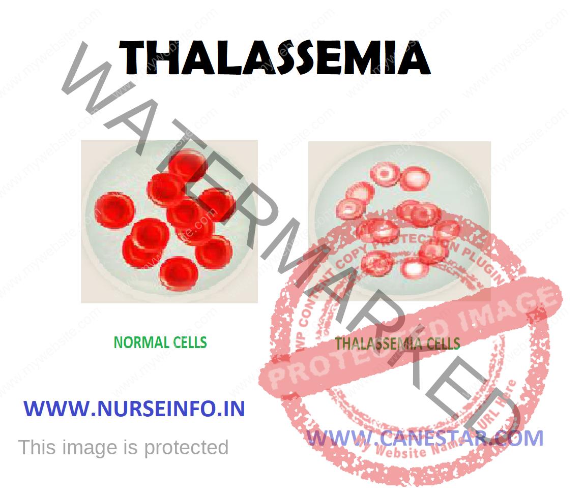 THALASSEMIA - Nurse Info