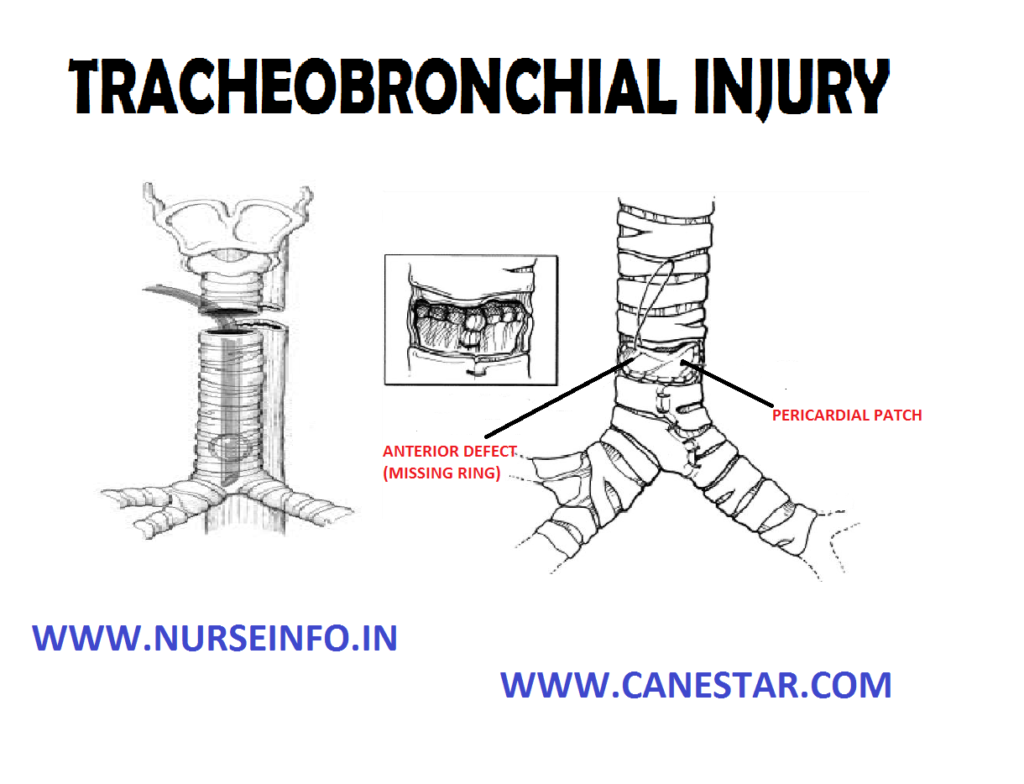 TRACHEOBRONCHIAL INJURY – Etiology, Clinical Manifestations, Diagnostic Evaluations and Management 