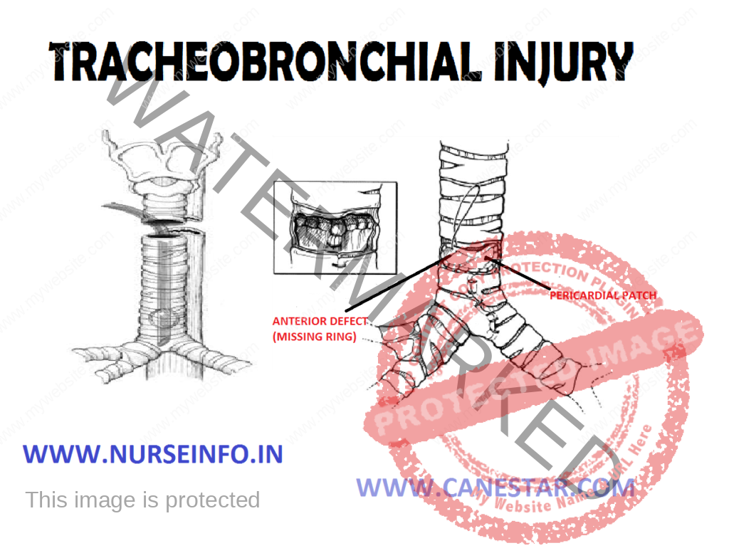 TRACHEOBRONCHIAL INJURY – Etiology, Clinical Manifestations, Diagnostic Evaluations and Management 