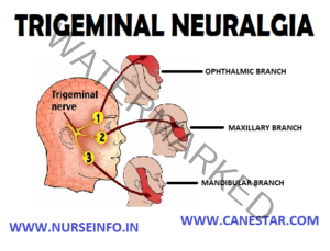 TRIGEMINAL NEURALGIA - Nurse Info