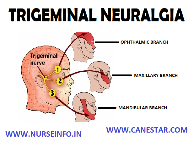 TRIGEMINAL NEURALGIA (‘TIC DOULOUREUX’) – Etiology, Signs and Symptoms, Types and Management