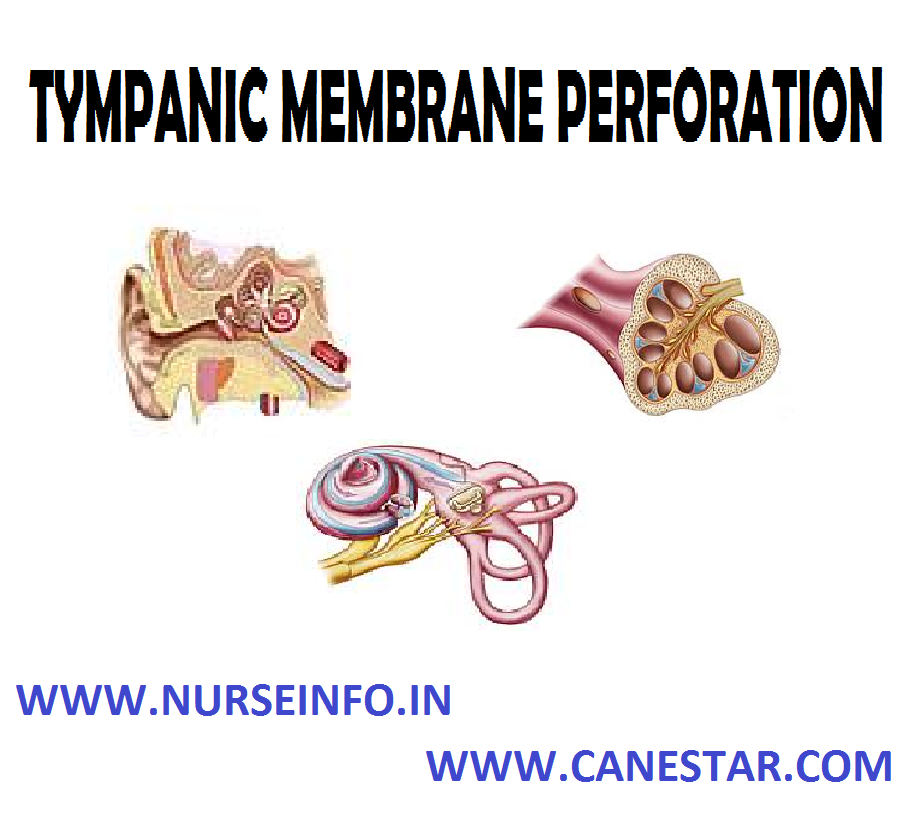 TYMPANIC MEMBRANE PERFORATION – Signs and Symptoms, Diagnostic Evaluation and Management 