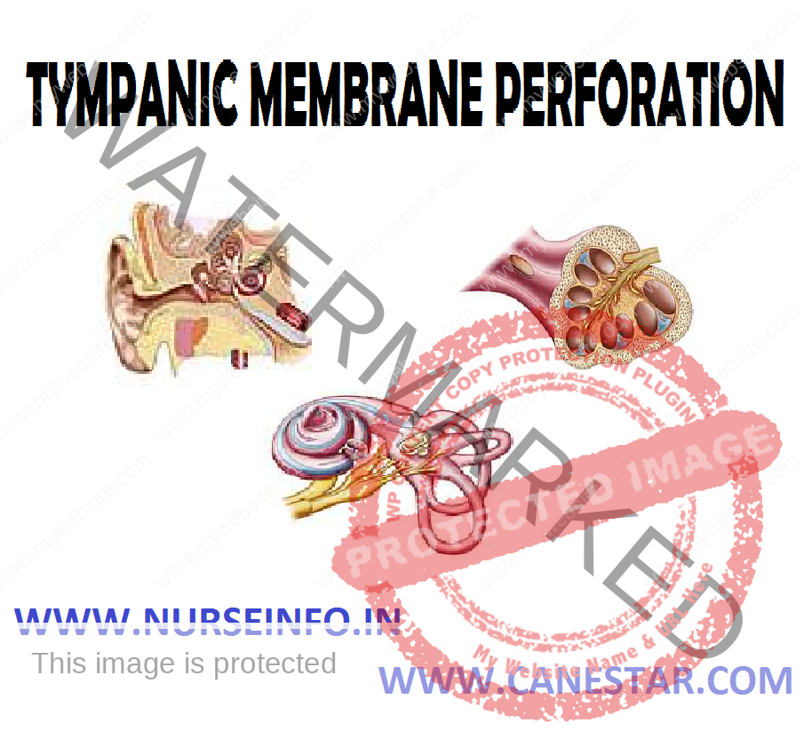 TYMPANIC MEMBRANE PERFORATION – Signs and Symptoms, Diagnostic Evaluation and Management 