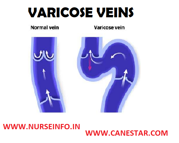 VARICOSE VEINS – Types, Stages, Etiology, Risk Factors, Clinical Manifestations, Diagnostic Evaluations and Management