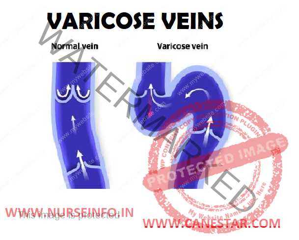 VARICOSE VEINS – Types, Stages, Etiology, Risk Factors, Clinical Manifestations, Diagnostic Evaluations and Management 