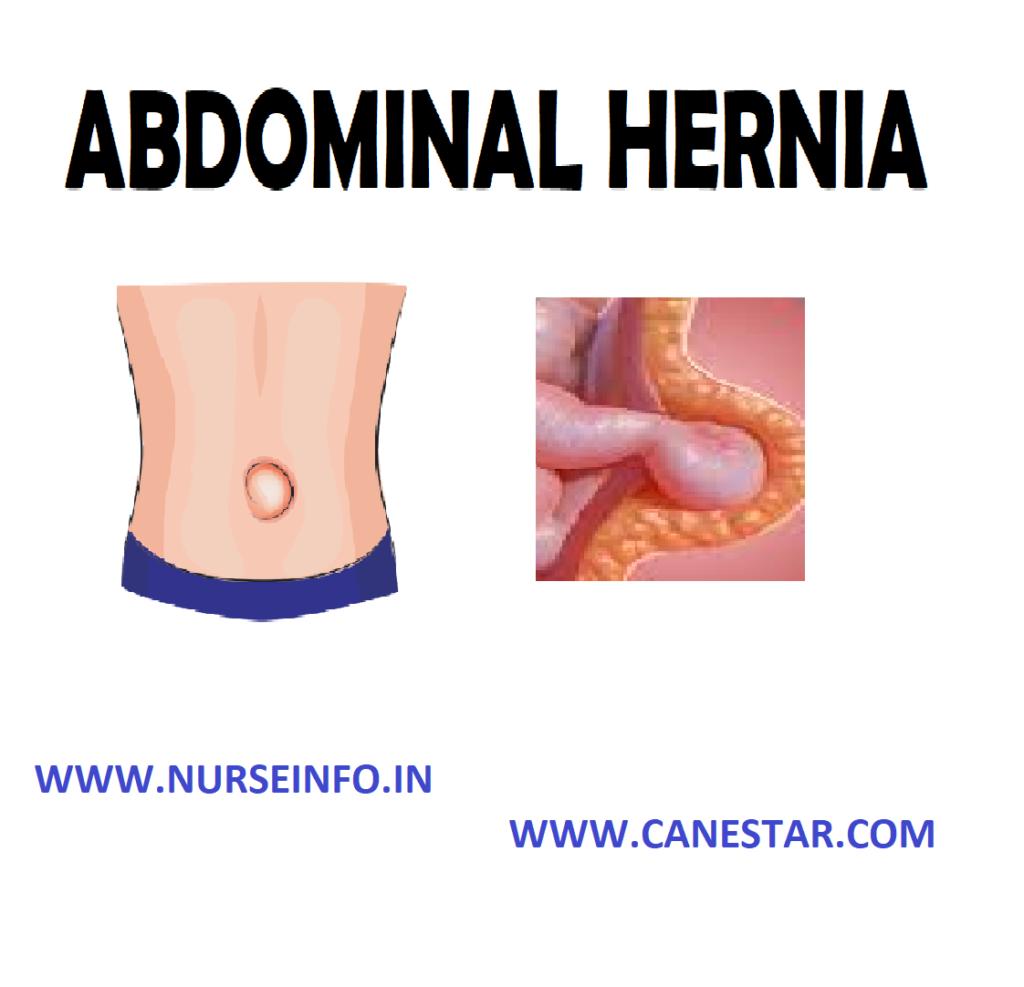 ABDOMINAL HERNIA – Etiology and Risk Factors, Signs and Symptoms, Types, Diagnostic Evaluation and Management
