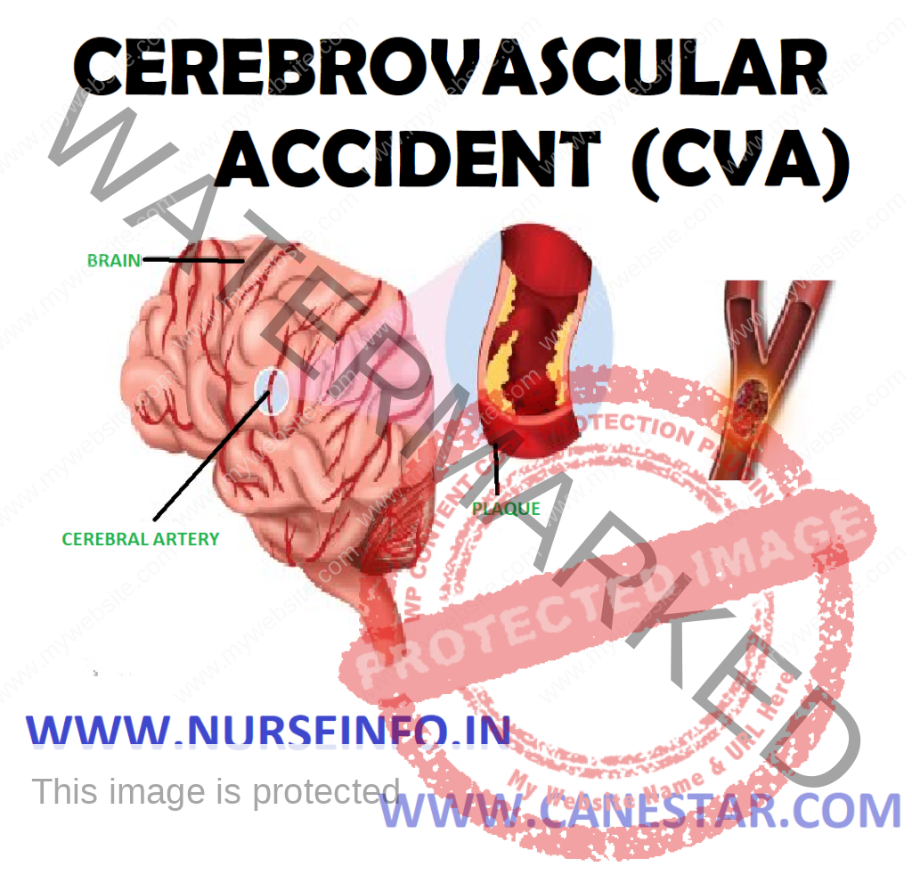 Cerebrovascular Accident Another Word