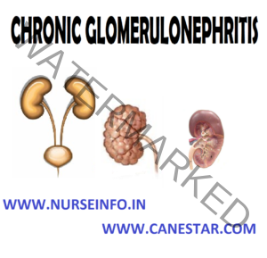 CHRONIC GLOMERULONEPHRITIS - Nurse Info