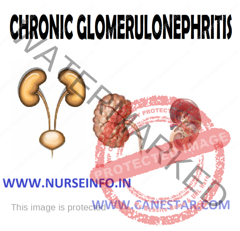 CHRONIC GLOMERULONEPHRITIS - Nurse Info