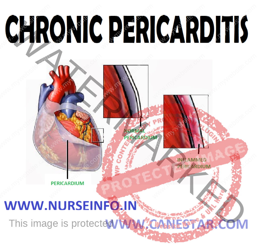 CHRONIC PERICARDITIS – Types, Causes, Pathophysiology, Diagnostic Evaluation, Clinical Features, Treatment and Management 