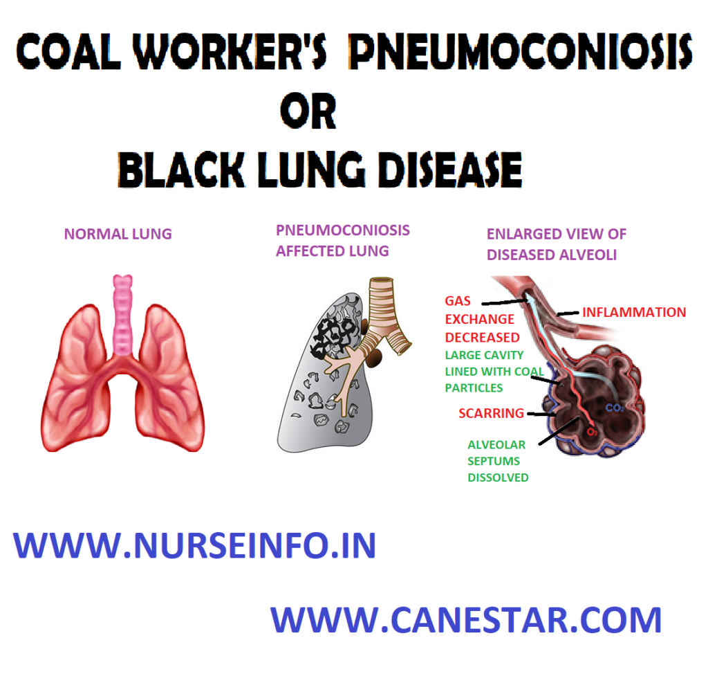 COAL WORKER’S PNEUMOCONIOSIS – Causes, Pathophysiology, Signs and Symptoms, Diagnostic Evaluation and Management
