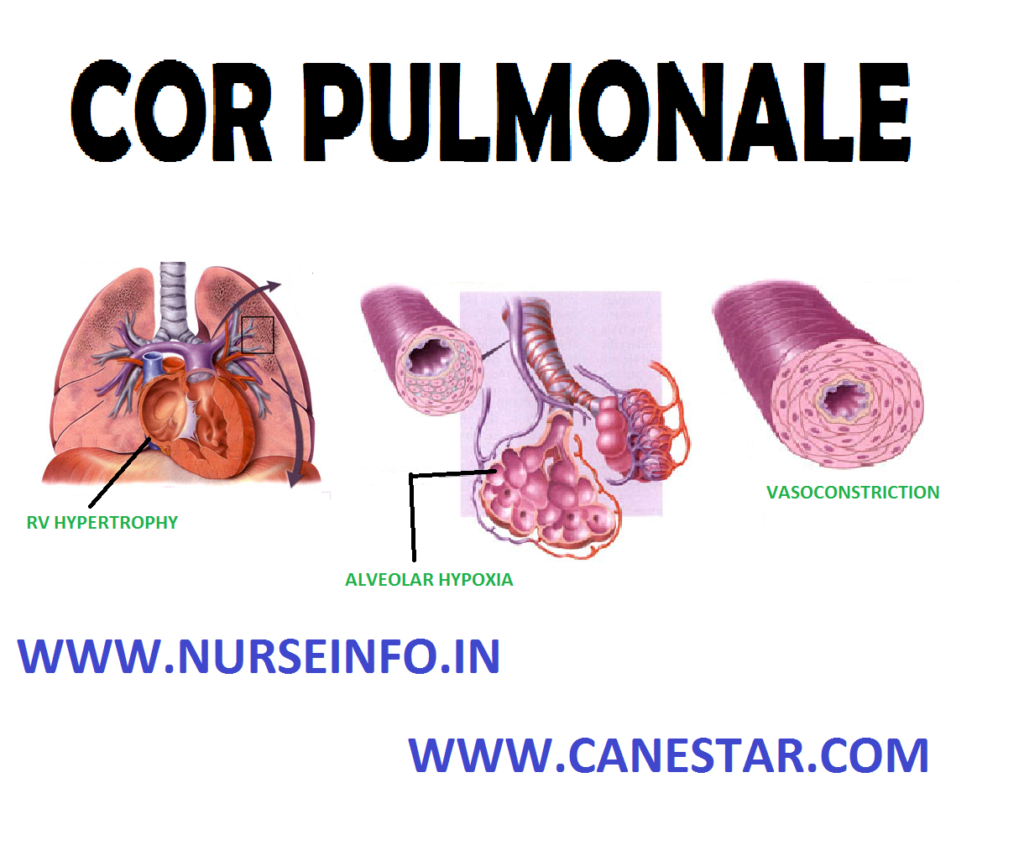 COR PULMONALE – Etiology, Clinical Manifestations, Diagnostic Evaluations and Management 
