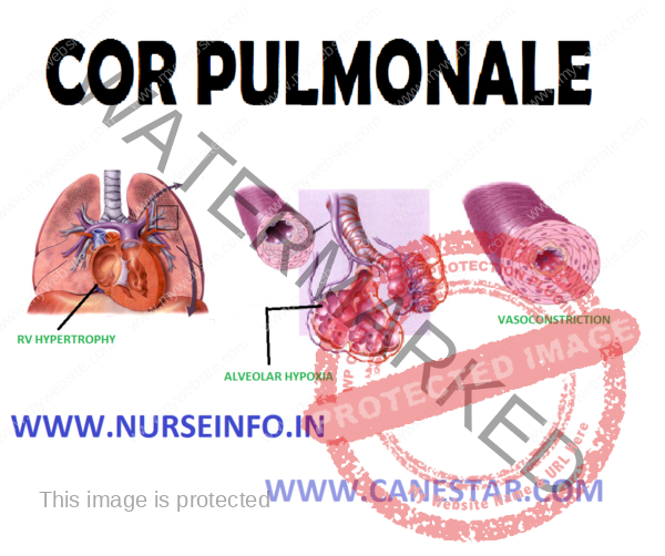 COR PULMONALE - Nurse Info