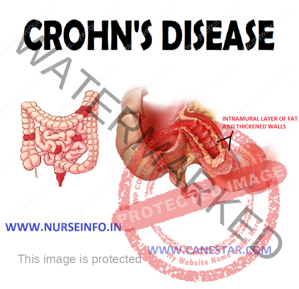 CROHN’S DISEASE Nurse Info