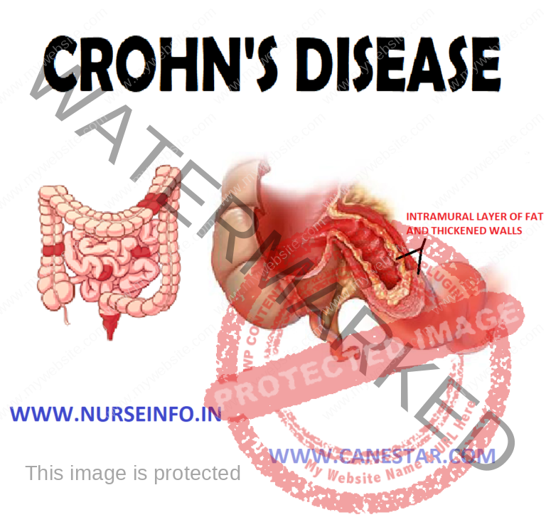CROHN’S DISEASE Nurse Info