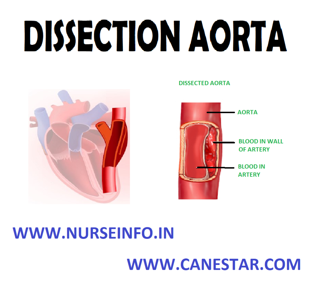 DISSECTION/DISSECTING AORTA – Definition, Incidence, Classification, Etiology, Pathophysiology, Risk Factors, Diagnostic Evaluation and Management