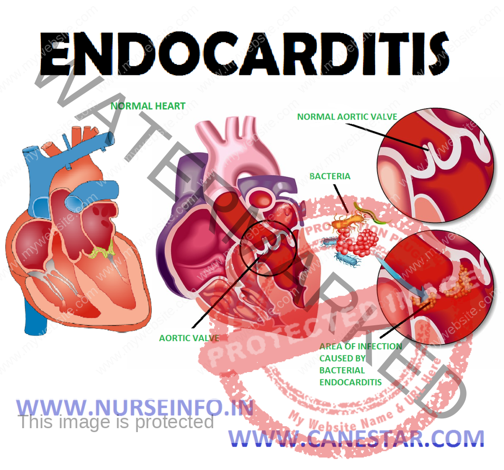 ENDOCARDITIS – Etiology, Risk Factors, Pathophysiology, Signs and Symptoms, Diagnostic Evaluation and Management 