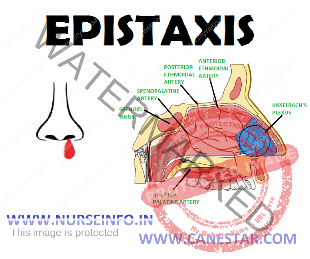 EPISTAXIS – Etiology, Diagnostic Evaluation and Management 