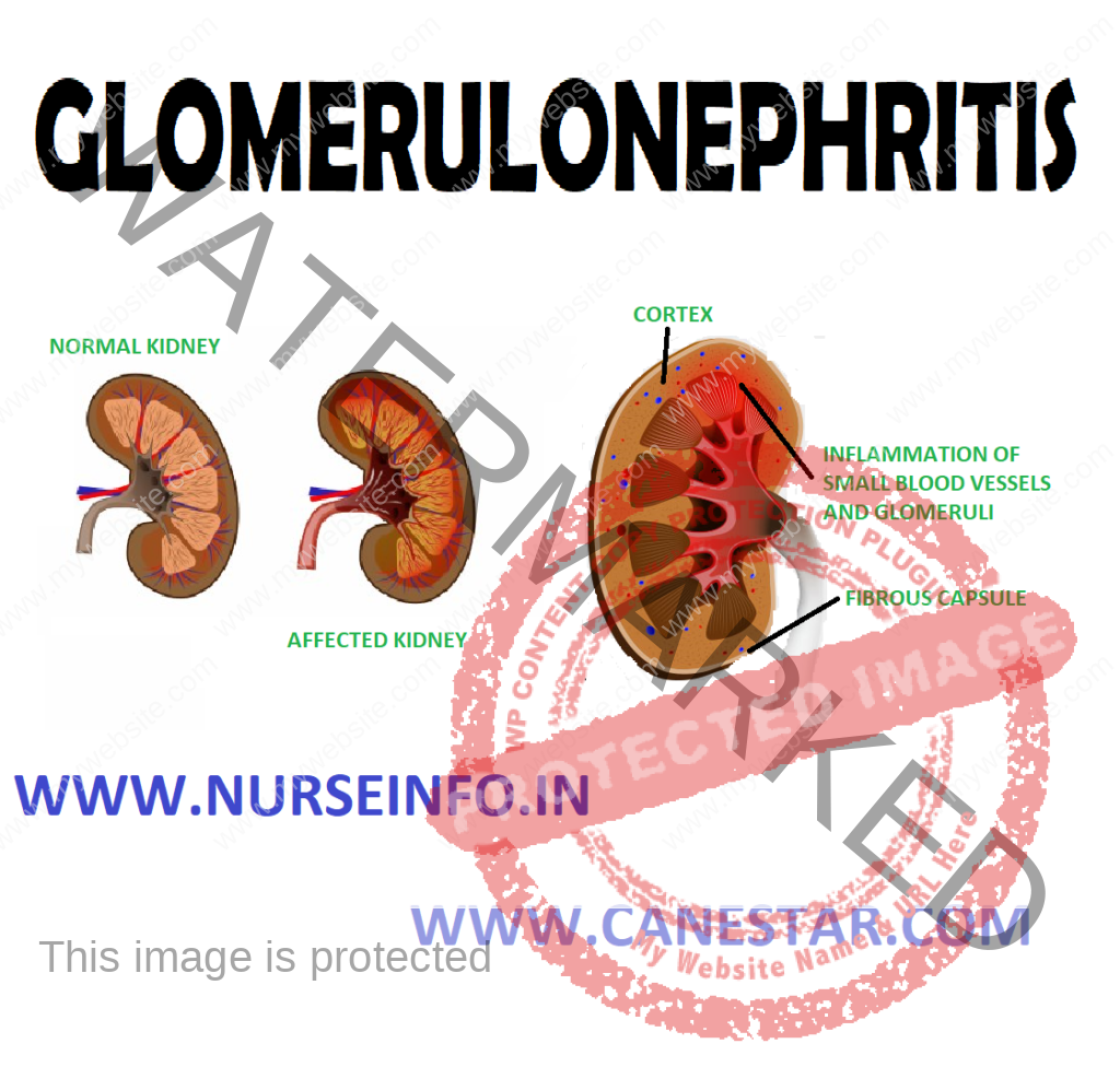 GLOMERULONEPHRITIS – Etiology, Types, Pathophysiology, Signs and Symptoms, Diagnostic Evaluation and Management 