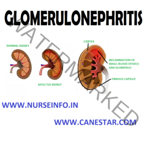 GLOMERULONEPHRITIS - Nurse Info