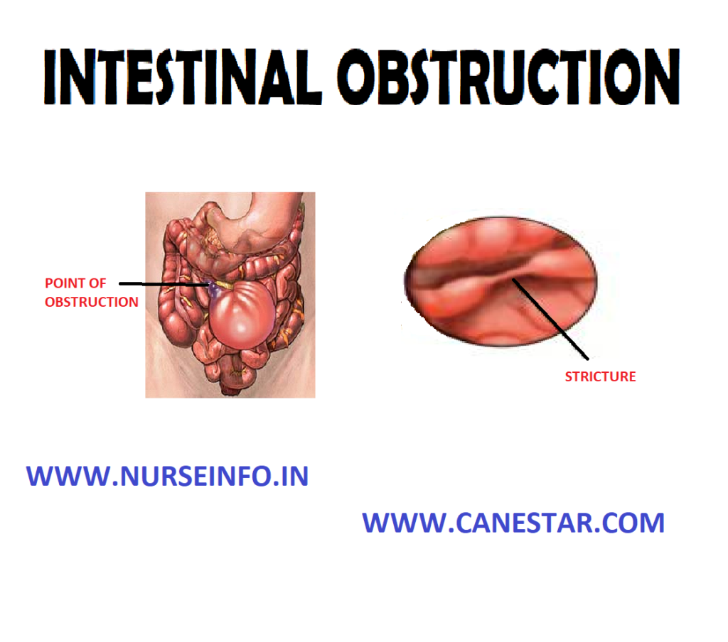 INTESTINAL OBSTRUCTION – Etiology, Risk Factors, Types, Signs and Symptoms, Pathophysiology, Diagnostic Evaluations and Management  