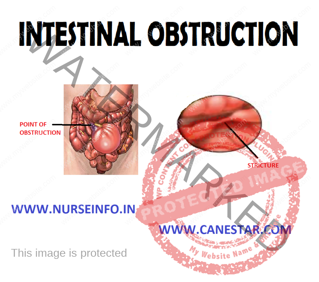 INTESTINAL OBSTRUCTION – Etiology, Risk Factors, Types, Signs and Symptoms, Pathophysiology, Diagnostic Evaluations and Management  