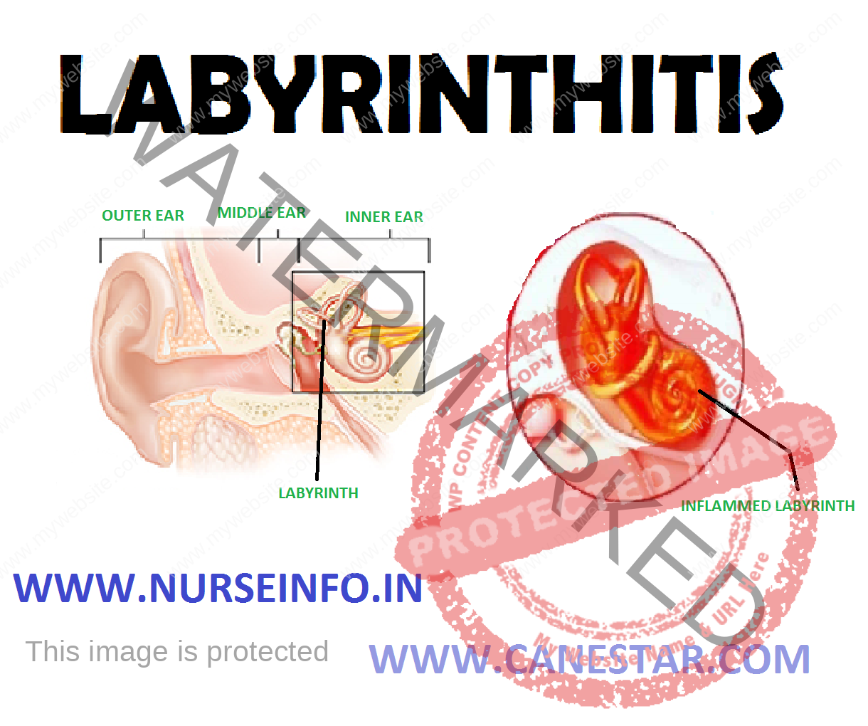 LABYRINTHITIS Nurse Info