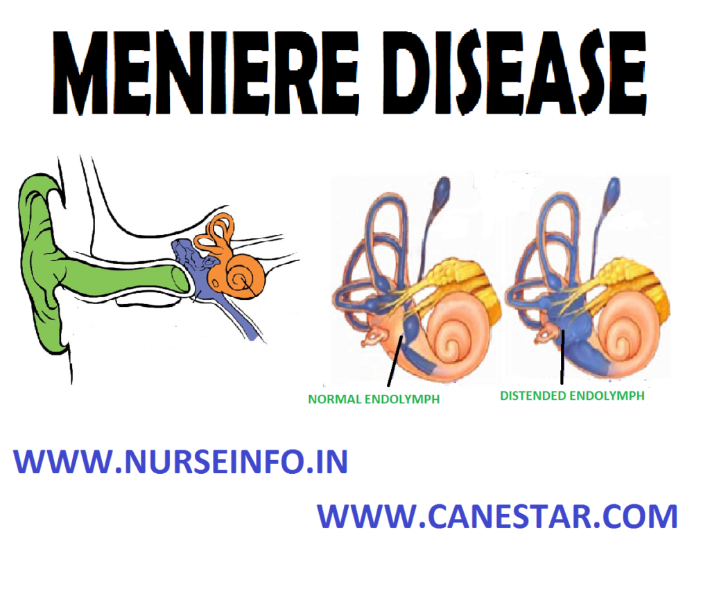 MENIERE’S DISEASE – Etiology, Signs and Symptoms, Diagnostic Evaluation and Management 