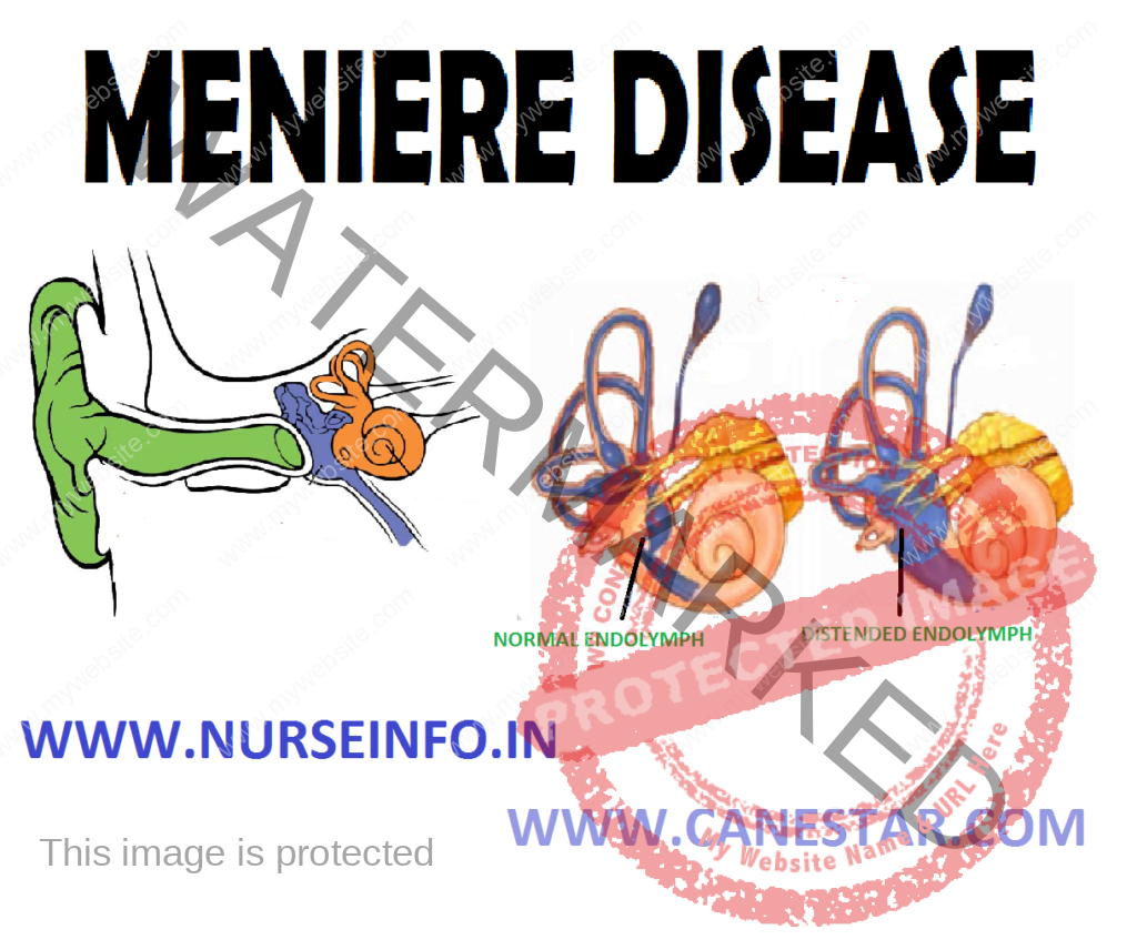 MENIERE’S DISEASE Nurse Info