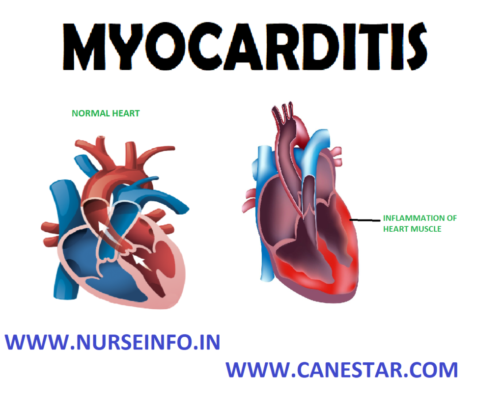 MYOCARDITIS - Etiology, Pathophysiology, Signs and Symptoms, Diagnostic Evaluation and Management 