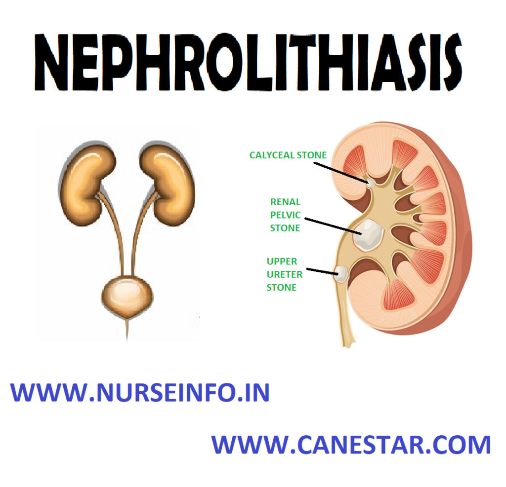 NEPHROLITHIASIS – Etiology, Risk Factors, Pathophysiology, Types, Signs and Symptoms, Diagnostic Evaluation and Management 