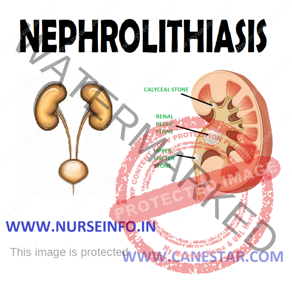 NEPHROLITHIASIS – Etiology, Risk Factors, Pathophysiology, Types, Signs and Symptoms, Diagnostic Evaluation and Management 