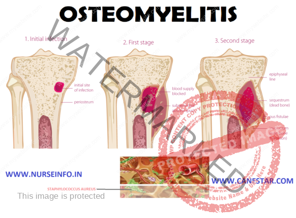 OSTEOMYELITIS - Nurse Info