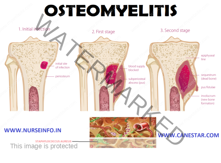 Que Es Cancer Osteomielitis