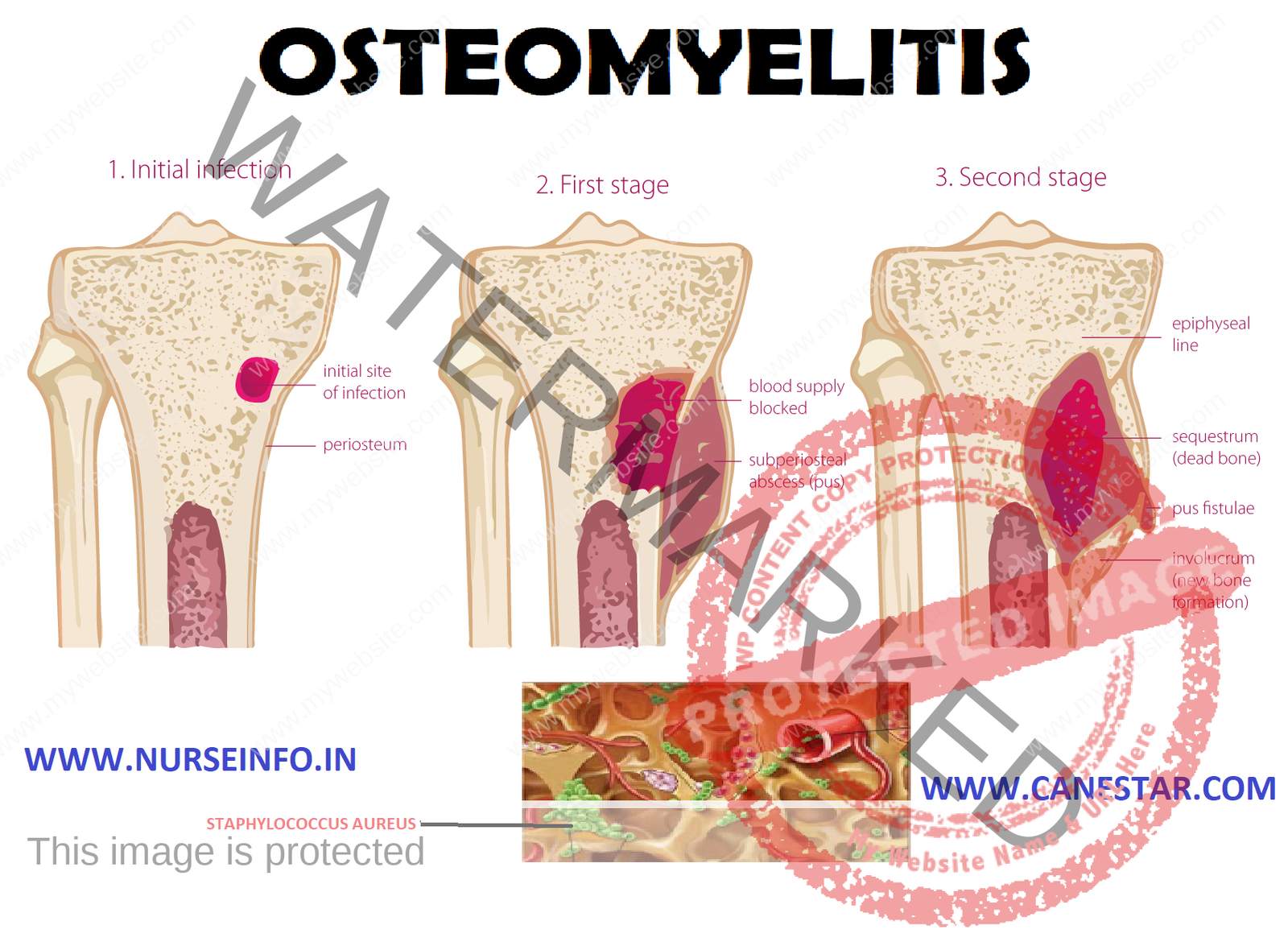 Osteomyelitis Nurse Info