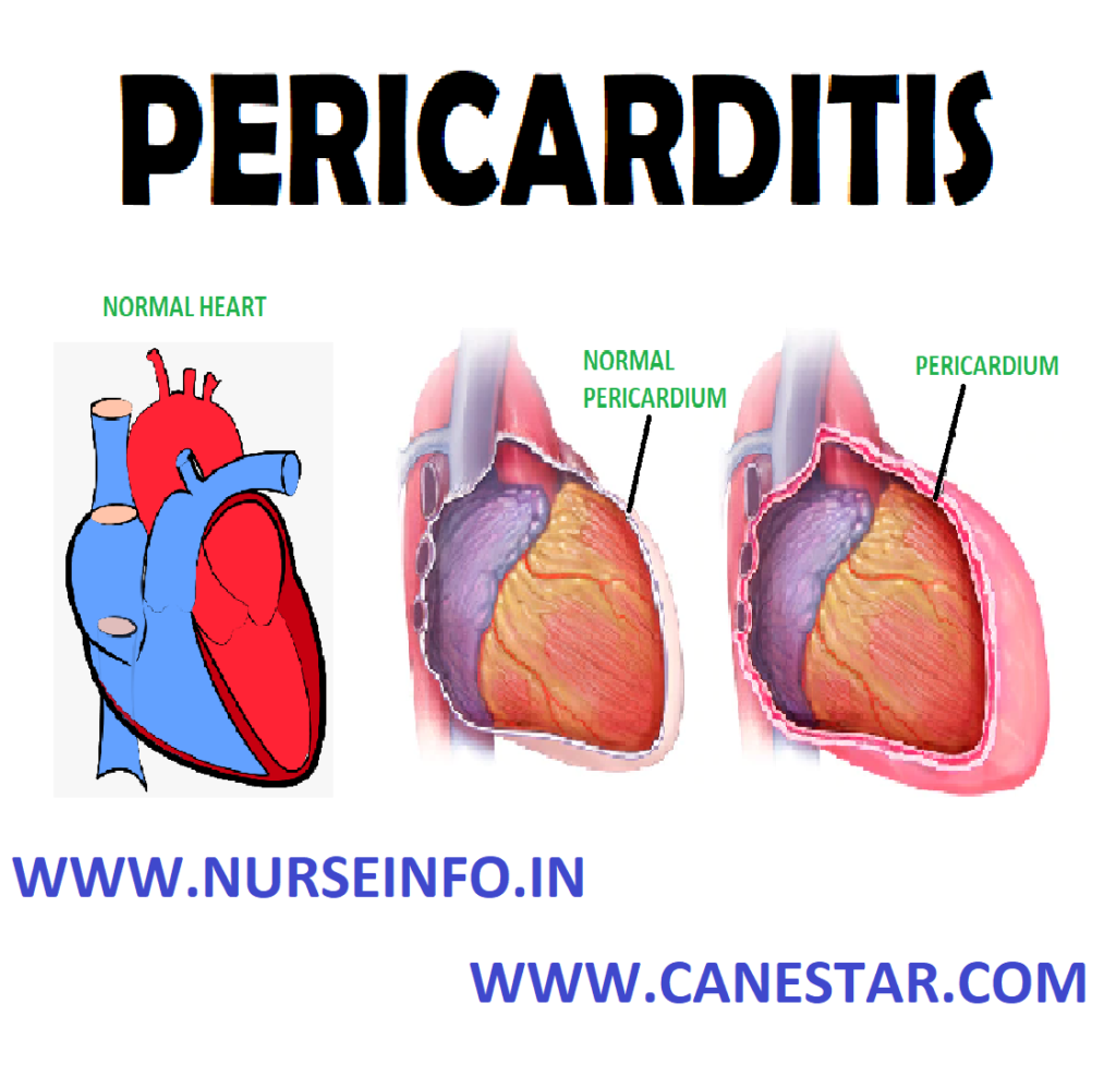 PERICARDITIS – Definition, Classification, Causes, Signs and Symptoms, Pathophysiology, Diagnostic Evaluations and Management