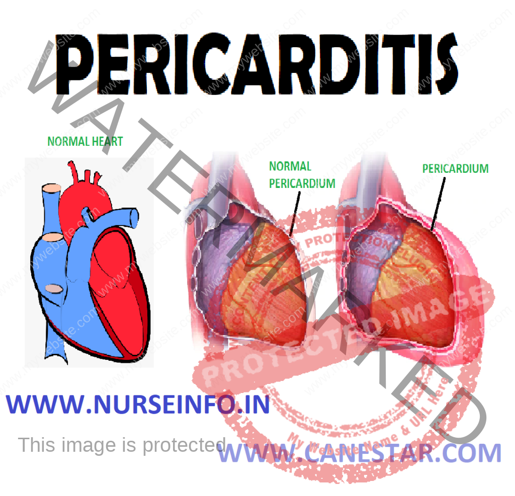 PERICARDITIS – Definition, Classification, Causes, Signs and Symptoms, Pathophysiology, Diagnostic Evaluations and Management 