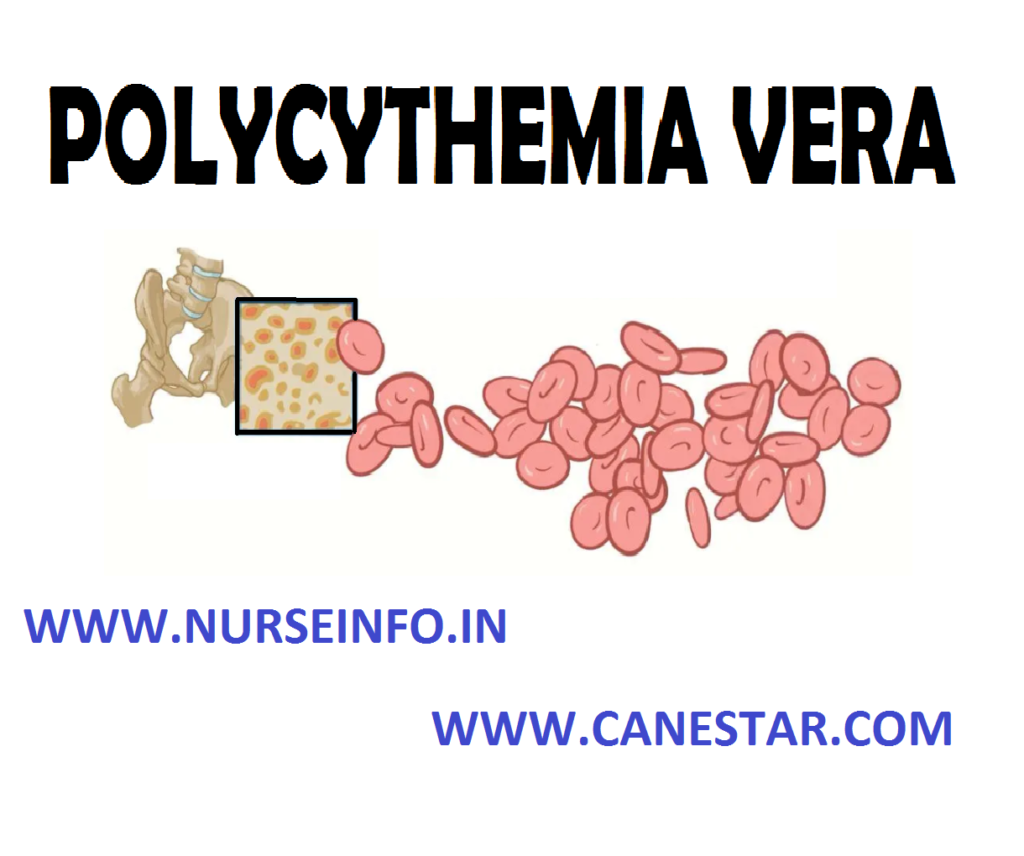 POLYCYTHEMIA VERA – Etiology, Risk Factors, Pathophysiology, Clinical Manifestations, Diagnostic Evaluation and Management
