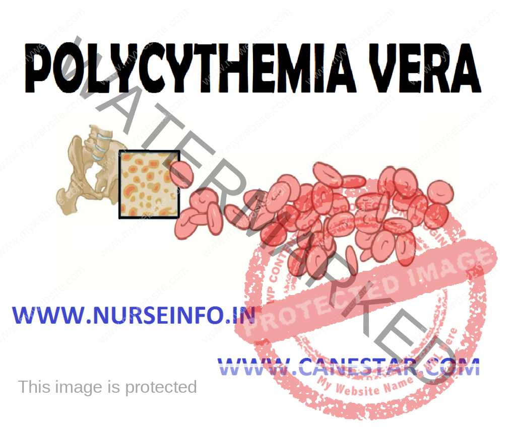 POLYCYTHEMIA VERA – Etiology, Risk Factors, Pathophysiology, Clinical Manifestations, Diagnostic Evaluation and Management 