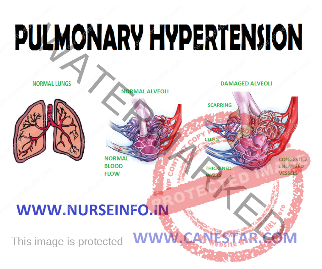 Types Of Pulmonary Hypertension The Who Groups