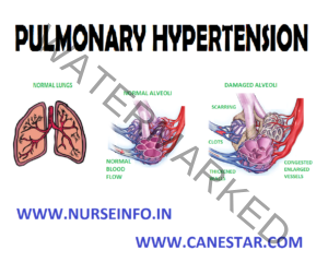 PULMONARY HYPERTENSION - Nurse Info