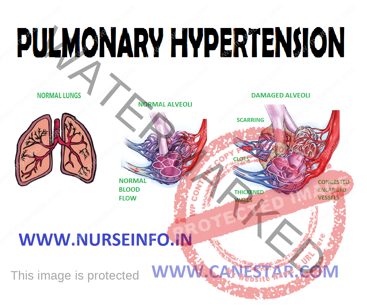 Pulmonary Hypertension Diagram
