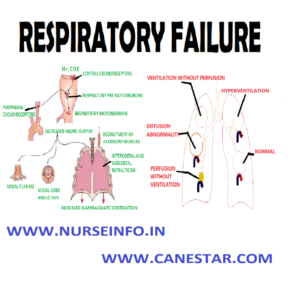 RESPIRATORY FAILURE – Classification, Etiology, Pathophysiology, Clinical Manifestation, Diagnostic Evaluation and Management