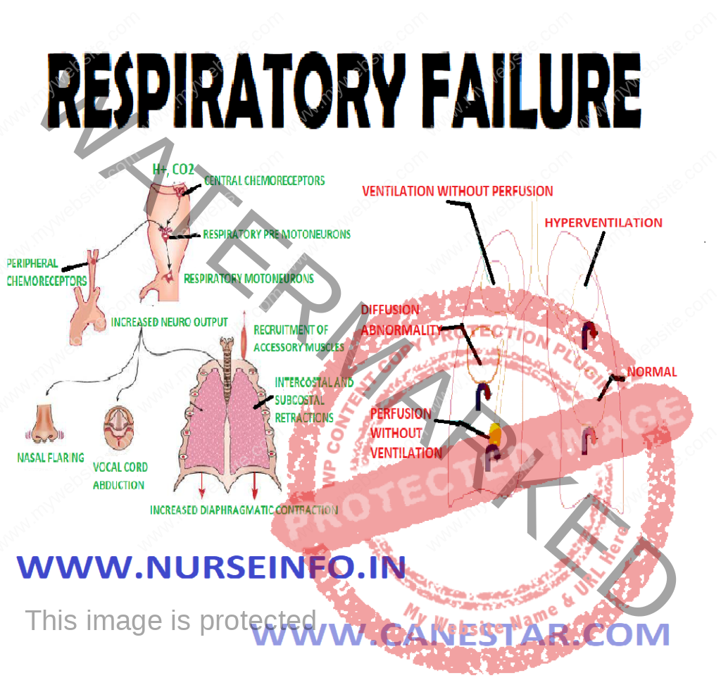 RESPIRATORY FAILURE – Classification, Etiology, Pathophysiology, Clinical Manifestation, Diagnostic Evaluation and Management 