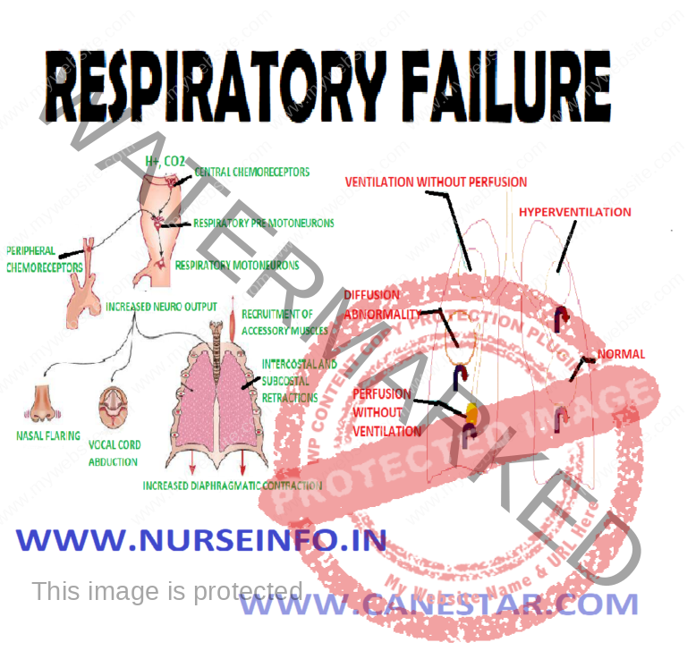 RESPIRATORY FAILURE - Nurse Info