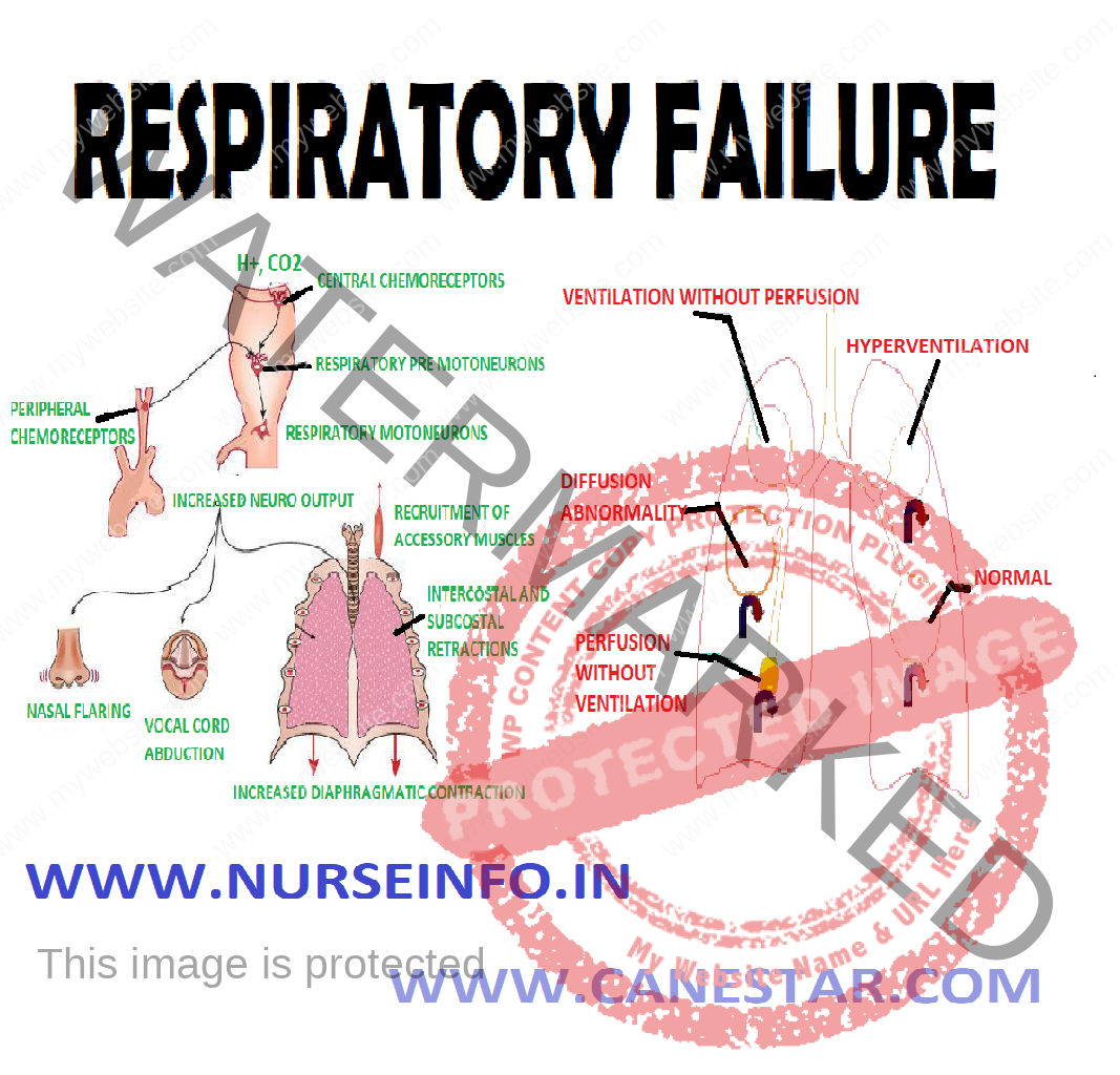 case study of respiratory failure