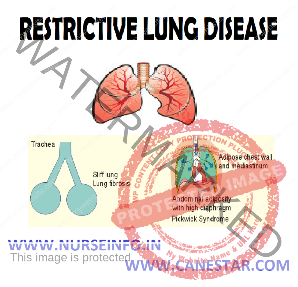 RESTRICTIVE LUNG DISEASES – Etiology, Pathophysiology, Signs and Symptoms, Diagnostic Evaluation and Management 