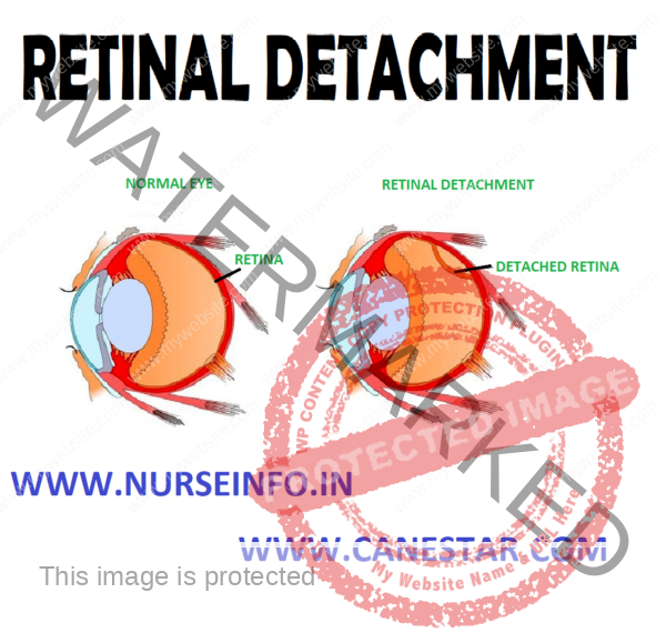 RETINAL DETACHMENT - Nurse Info