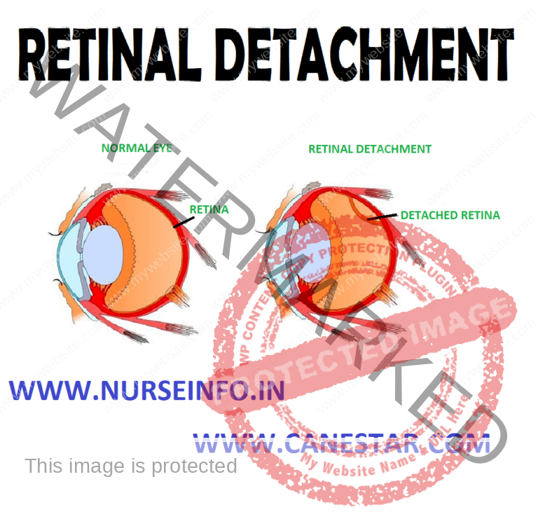 retinal detachment causes